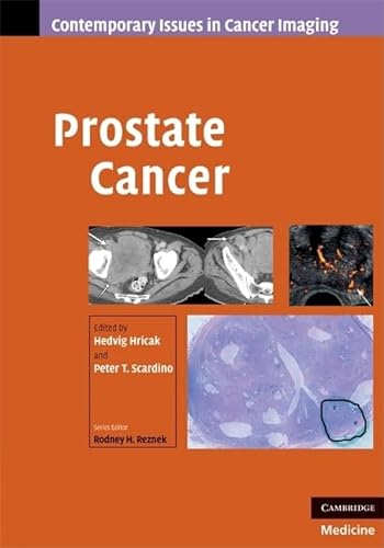 Beispielbild fr Prostate Cancer zum Verkauf von Anybook.com