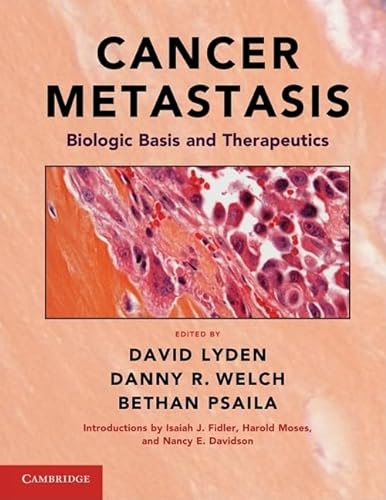 Cancer Metastasis: Biologic Basis and Therapeutics