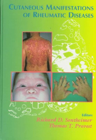 Stock image for Cutaneous Manifestations of Rheumatic Diseases for sale by HPB-Red