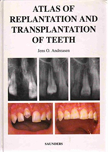 Atlas of Replantation and Transplantation of Teeth (9780721667119) by Andreasen, Jens O.