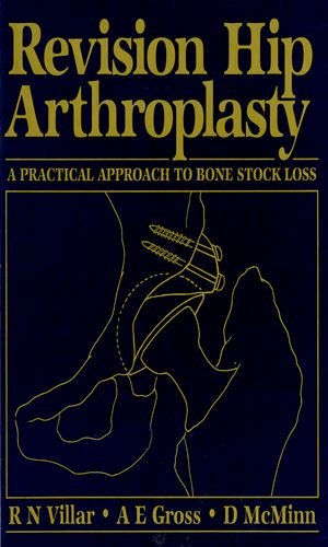 9780750616409: Revision Hip Arthroplasty: A Practical Approach to Bone Stock Loss