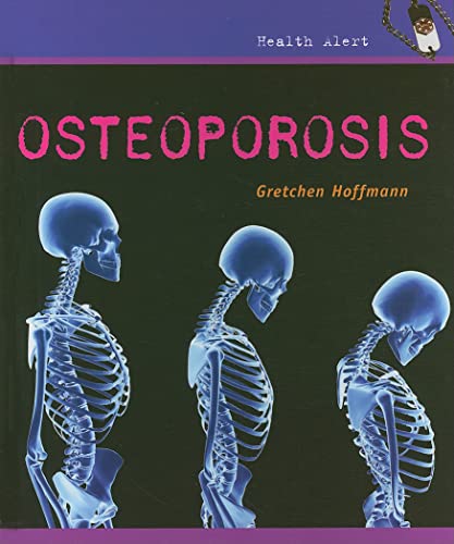 9780761427025: Osteoporosis (Health Alert)