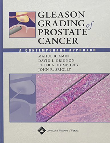 Beispielbild fr Gleason Grading of Prostate Cancer: A Contemporary Approach zum Verkauf von Solr Books