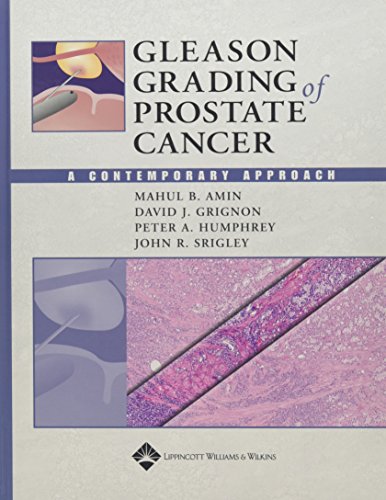 Gleason Grading of Prostate Cancer: A Contemporary Approach (9780781742795) by Grignon, David, M.D.; Humphrey, Peter A.; Srigley, John R., M.D.