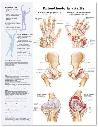 Entendiendo la artritis / Understanding Arthritis Anatomical Chart: Entendiendo La Artritis (Spanish Edition) (9780781773027) by Anatomical Chart Company