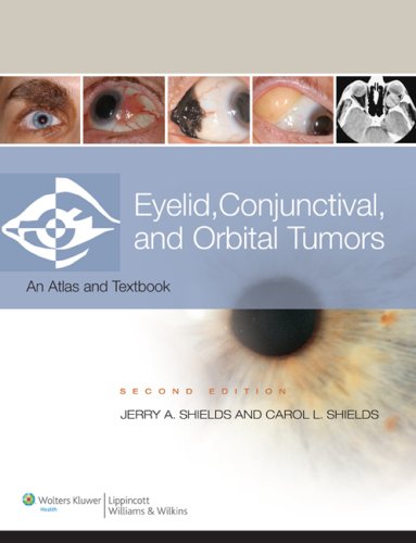 9780781775816: Eyelid, Conjunctival, and Orbital Tumors and Intraocular Tumors: An Atlas and Text (Two-Volume Set)