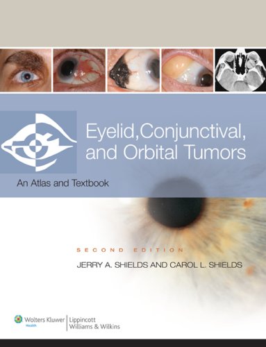 Stock image for Eyelid, Conjunctival and Orbital Tumors and Intraocular Tumors for sale by Books Puddle