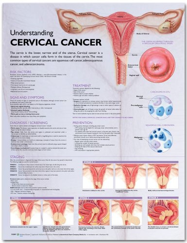 Understanding Cervical Cancer Anatomical Chart (9780781776554) by Anatomical Chart Company