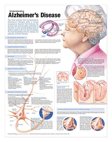 Understanding Alzheimer's Disease Anatomical Chart (9780781786348) by Acc