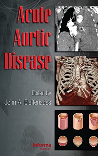 9780849370236: Acute Aortic Disease