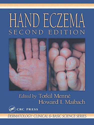 Stock image for Hand Eczema (CRC series in dermatology) for sale by HPB-Red
