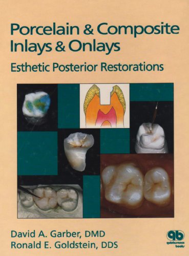 Stock image for Porcelain Composite Inlays Onlays: Esthetic Posterior Restorations for sale by Bulk Book Warehouse