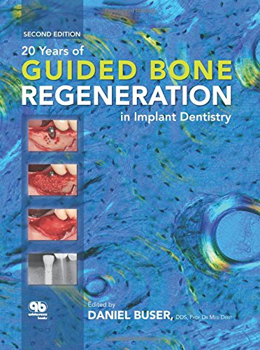 9780867154016: 20 Years of Guided Bone Regeneration in Implant Dentistry
