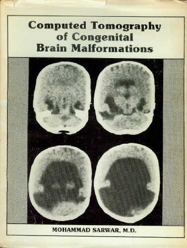 9780875272313: Computed Tomography of Congenital Brain Malformations