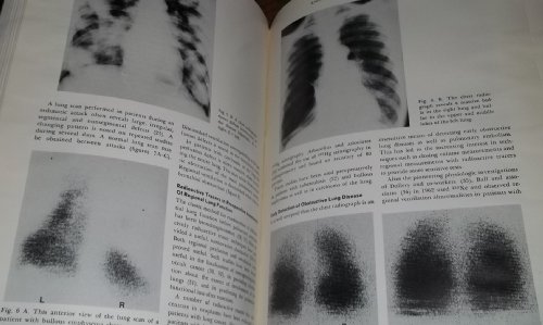 Stock image for Lung Disease: State of the Art, 1975-76 for sale by K & L KICKIN'  BOOKS