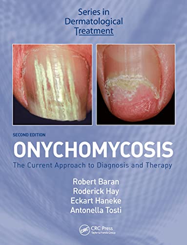 Imagen de archivo de Onychomycosis (French Edition) a la venta por HPB-Red