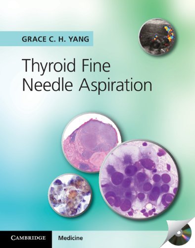 Stock image for Thyroid Fine Needle Aspiration for sale by Labyrinth Books