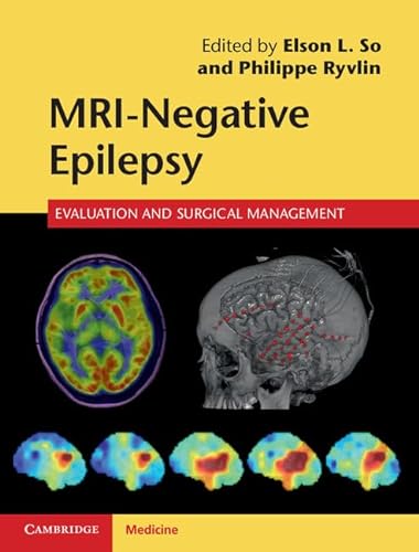 Beispielbild fr MRI-Negative Epilepsy: Evaluation and Surgical Management [Hardcover] So, Elson L. zum Verkauf von Brook Bookstore