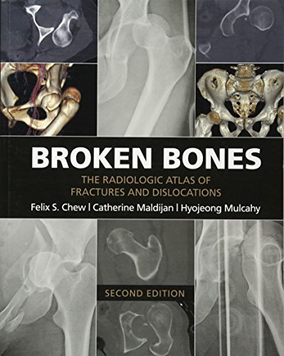 Stock image for Broken Bones: The Radiologic Atlas of Fractures and Dislocations for sale by Prior Books Ltd