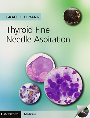 Stock image for Thyroid Fine Needle Aspiration with CD Extra for sale by Prior Books Ltd