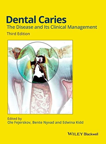 Imagen de archivo de Dental Caries: The Disease and its Clinical Management a la venta por WorldofBooks