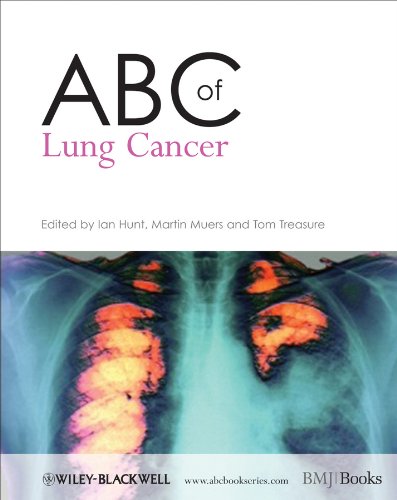 Imagen de archivo de ABC of Lung Cancer a la venta por Better World Books