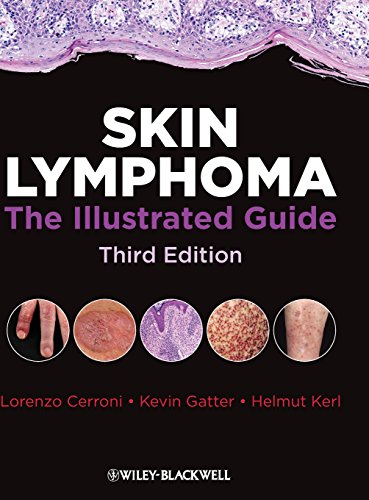 Skin Lymphoma: The Illustrated Guide (9781405185547) by Cerroni, Lorenzo; Gatter, Kevin; Helmut, Kerl