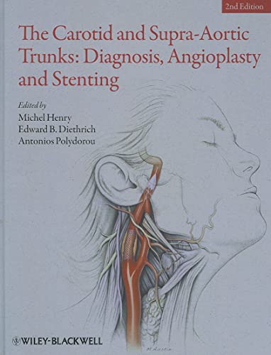 Stock image for The Carotid and Supra-Aortic Trunks: Diagnosis, Angioplasty and Stenting for sale by Palexbooks