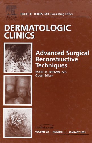 Beispielbild fr Advanced Surgical Techniques, An Issue of Dermatologic Clinics (Volume 23-1) (The Clinics: Dermatology, Volume 23-1) zum Verkauf von HPB-Red