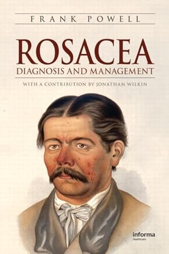 9781420072587: Rosacea: Diagnosis and Management