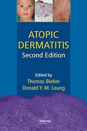 Stock image for Atopic Dermatitis for sale by Blackwell's