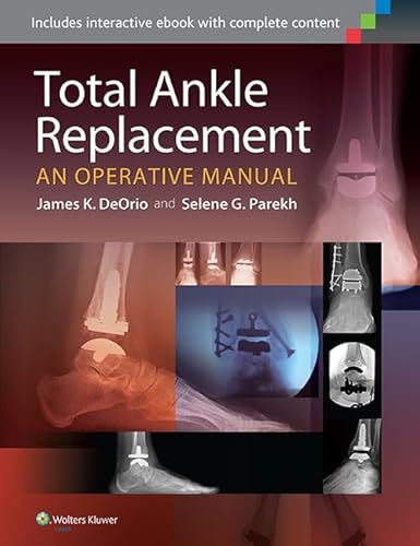 Stock image for TOTAL ANKLE REPLACEMENT: AN OPERATIVE MANUAL (HB 2014) for sale by Romtrade Corp.