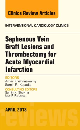 Stock image for Saphenous Vein Graft Lesions and Thrombectomy for Acute Myocardial Infarction, An Issue of Interventional Cardiology Clinics, 1e (The Clinics: Internal Medicine) for sale by Chiron Media