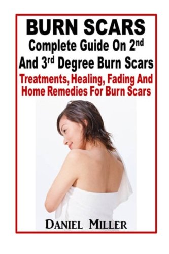 Burn Scars : Complete Guide On 2nd And 3rd Degree Burn Scars: Treatments, Healing, Fading And Home Remedies For Burn Scars (9781481110068) by Miller, Daniel