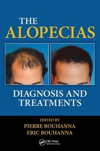 Stock image for The Alopecias: Diagnosis and Treatments for sale by SecondSale
