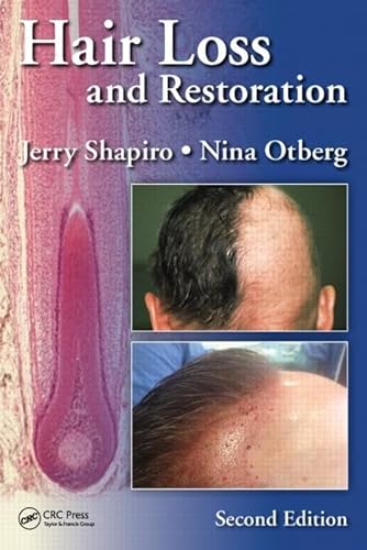 Stock image for Hair Loss And Restoration 2Ed (Hb 2015) for sale by Basi6 International