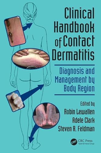 Stock image for Clinical Handbook of Contact Dermatitis : Diagnosis and Management by Body Region for sale by Better World Books Ltd