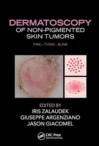 9781482237528: Dermatoscopy of Non-Pigmented Skin Tumors: Pink - Think - Blink