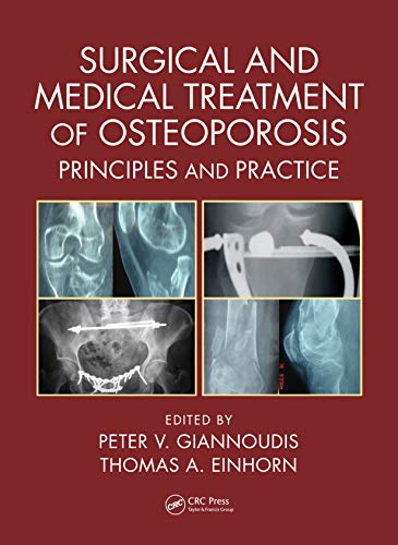 Imagen de archivo de Surgical And Medical Treatment Of Osteoporosis Principles And Practice (Hb 2020) a la venta por Basi6 International