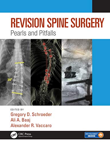 9781498773829: Revision Spine Surgery: Pearls and Pitfalls