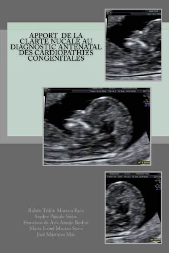 Imagen de archivo de Apport de la clart nucale au diagnostic antnatal des cardiopathies congnital a la venta por Revaluation Books