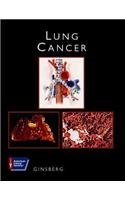 Beispielbild fr Lung Cancer zum Verkauf von HPB-Red