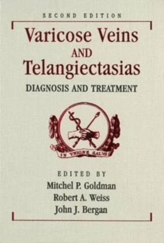 Beispielbild für Varicose Veins and Telangiectasias: Diagnosis and Treatment zum Verkauf von SecondSale