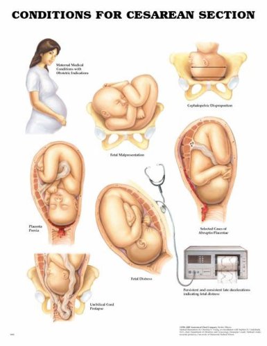 Conditions For Cesarean Section Anatomical Chart (9781587792243) by Anatomical Chart Company