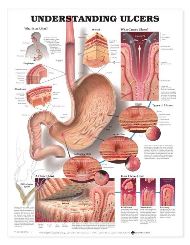 Understanding Ulcers Anatomical Chart (9781587793714) by Anatomical Chart Company