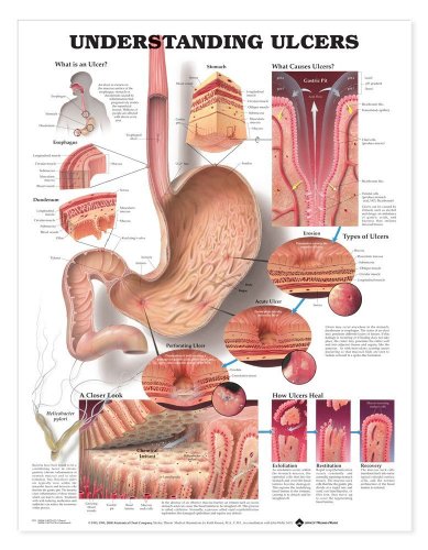 9781587793714: Understanding Ulcers Anatomical Chart