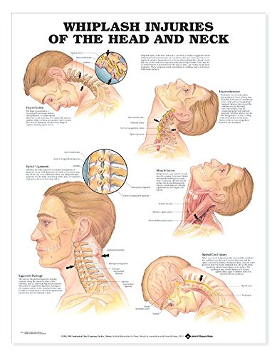 Stock image for Whiplash Injuries of the Head and Neck Anatomical Chart for sale by Revaluation Books