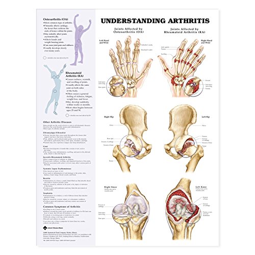 Osteoarthritis and Rheumatoid Arthritis Anatomical Chart (9781587793875) by [???]