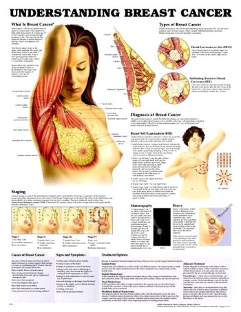 Understanding Breast Cancer (9781587794971) by Anatomical Chart Company