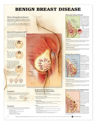 Benign Breast Disease Anatomical Chart (9781587797323) by Anatomical Chart Company